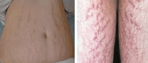 Da bao quy đầu bị rạn nứt